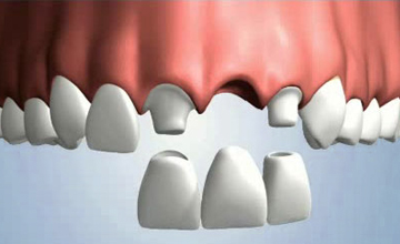 Achieve Dental bridge service