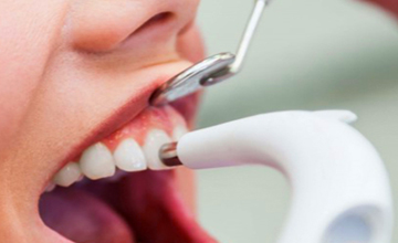 Achieve Dental cleaning service