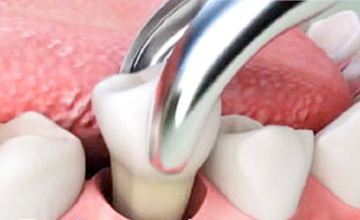 Achieve Dental Tooth Extractions service