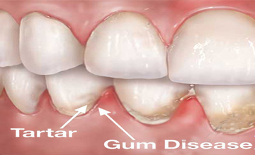 Achieve Dental Periodontal (Gum) Disease service