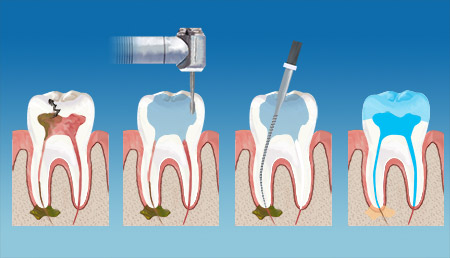 Achieve Dental Endodontics Therapy service
